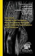 Changes in the Cerebellum, Pons, and Medulla Oblongata due to Congenital Hydrocephalus of the Cerebrum