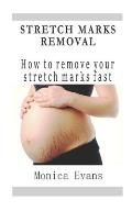 Stretch Marks Removal: How to remove your stretch marks fast