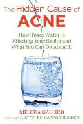 Hidden Cause of Acne