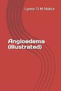 Angioedema (illustrated)
