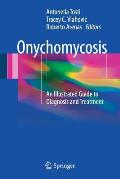 Onychomycosis: An Illustrated Guide to Diagnosis and Treatment