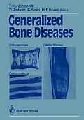 Generalized Bone Diseases: Osteoporosis Osteomalacia Ostitis Fibrosa