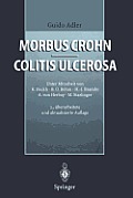 Morbus Crohn - Colitis Ulcerosa